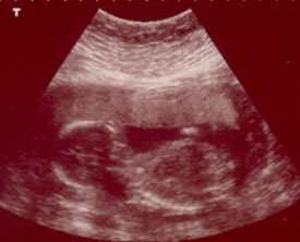 Profile ~ Head, Belly And Spine At Bottom